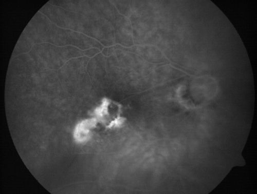 Macular Fold - 40 years post retinal detachment repair - Glaucoma 
79-year-old woman has had a long-standing macular fold in the right eye associated with retinal detachment repair in 1970. (40 years ago) She has a macular scar in that eye.  She has optic atrophy in both eyes from glaucoma.   Vision OD is hand motion, OS is 20/50
