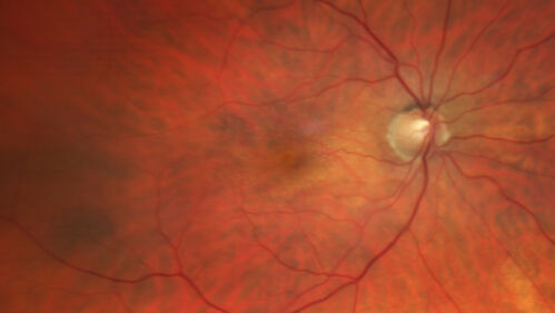 Reticular pseudodrusen
