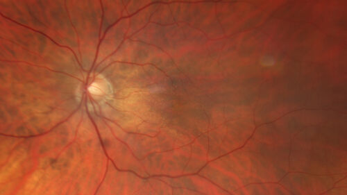 Reticular pseudodrusen
