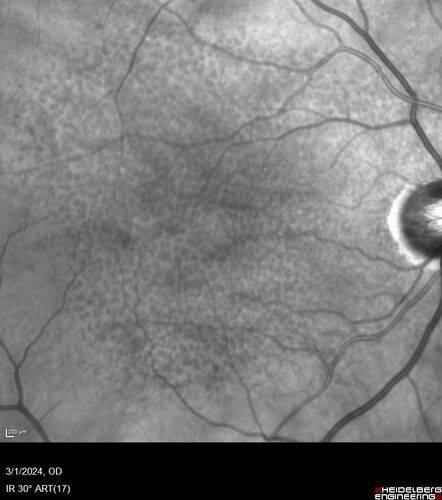 Reticular pseudodrusen
