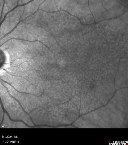 Reticular pseudodrusen
