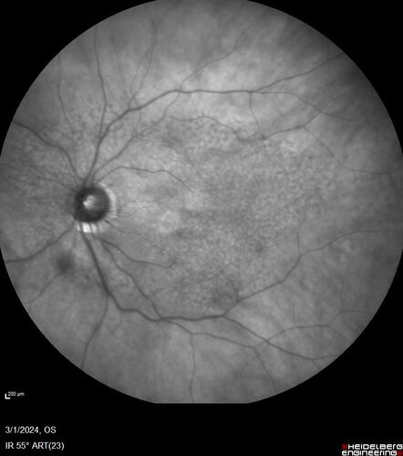 Reticular pseudodrusen
