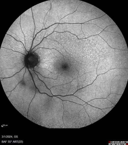 Reticular pseudodrusen

