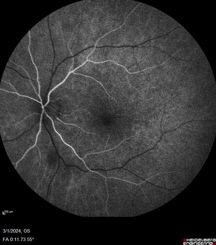 Reticular pseudodrusen
