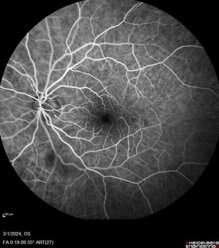 Reticular pseudodrusen
