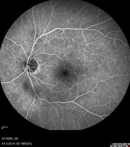 Reticular pseudodrusen
