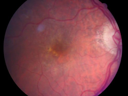 Reticular Macular Disease (Pseudo-drusen) Both Eyes - Wet AMD OS - Dry AMD OD 
84-year-old woman has wet age-related macular degeneration in the left eye and dry macular degeneration in the right eye.  She takes the eye vitamins and her vision is stable since she was treated three months ago with Avastin.   OD 20/50,  OS 20/32
