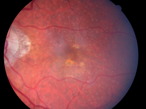 Reticular Macular Disease (Pseudo-drusen) Both Eyes - Wet AMD OS - Dry AMD OD 
84-year-old woman has wet age-related macular degeneration in the left eye and dry macular degeneration in the right eye.  She takes the eye vitamins and her vision is stable since she was treated three months ago with Avastin.   OD 20/50,  OS 20/32
