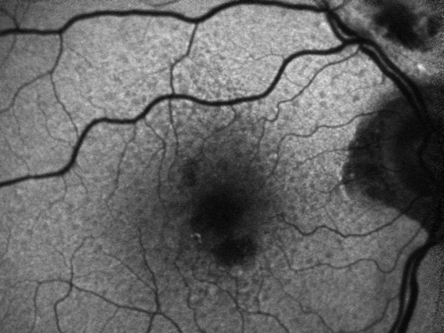 Reticular Macular Disease (Pseudo-drusen) Both Eyes - Wet AMD OS - Dry AMD OD FAF
84-year-old woman has wet age-related macular degeneration in the left eye and dry macular degeneration in the right eye.  She takes the eye vitamins and her vision is stable since she was treated three months ago with Avastin.   OD 20/50,  OS 20/32
