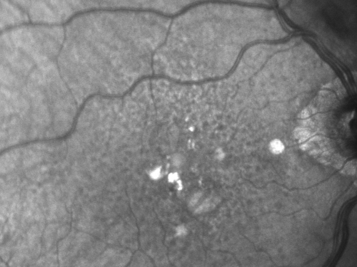Reticular Macular Disease (Pseudo-drusen) Both Eyes - Wet AMD OS - Dry AMD OD InfraRed
84-year-old woman has wet age-related macular degeneration in the left eye and dry macular degeneration in the right eye.  She takes the eye vitamins and her vision is stable since she was treated three months ago with Avastin.   OD 20/50,  OS 20/32
