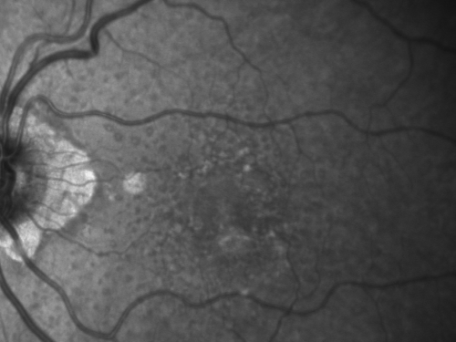 Reticular Macular Disease (Pseudo-drusen) Both Eyes - Wet AMD OS - Dry AMD OD InfraRed
84-year-old woman has wet age-related macular degeneration in the left eye and dry macular degeneration in the right eye.  She takes the eye vitamins and her vision is stable since she was treated three months ago with Avastin.   OD 20/50,  OS 20/32
