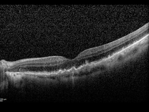 Reticular Macular Disease (Pseudo-drusen) Both Eyes - Wet AMD OS - Dry AMD OD SD-OCT
84-year-old woman has wet age-related macular degeneration in the left eye and dry macular degeneration in the right eye.  She takes the eye vitamins and her vision is stable since she was treated three months ago with Avastin.   OD 20/50,  OS 20/32
