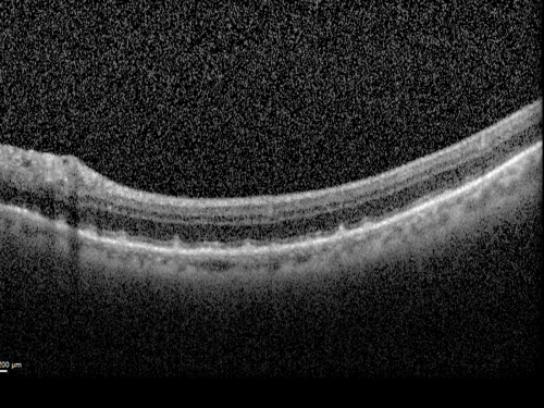 Reticular Macular Disease (Pseudo-drusen) Both Eyes - Wet AMD OS - Dry AMD OD SD-OCT
84-year-old woman has wet age-related macular degeneration in the left eye and dry macular degeneration in the right eye.  She takes the eye vitamins and her vision is stable since she was treated three months ago with Avastin.   OD 20/50,  OS 20/32
