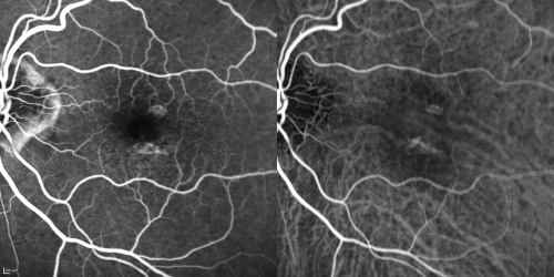 Reticular Macular Disease (Pseudo-drusen) Both Eyes - Wet AMD OS - Dry AMD OD FA and ICG early
84-year-old woman has wet age-related macular degeneration in the left eye and dry macular degeneration in the right eye.  She takes the eye vitamins and her vision is stable since she was treated three months ago with Avastin.   OD 20/50,  OS 20/32
