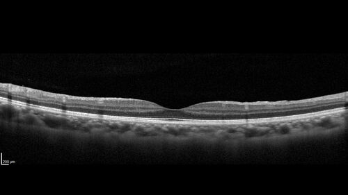 Type 1 Retinal Arteriovenous Malformation
42 year old female VA 20/32 OD, 20/20 OS MRI was negative.
