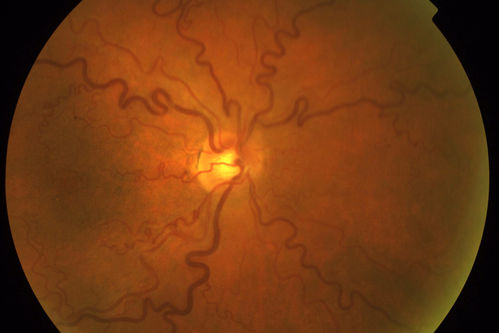 50 Year Old woman with Congenital Retinal Vascular Tortuosity - Normal Vision
