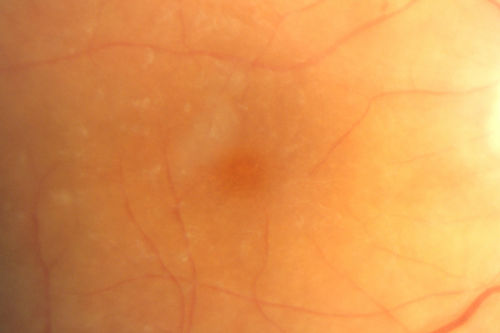 Birdshot Chorioretintis and PAMM
Patient presented with paracentral acute middle maculopathy as the presenting symptom of birdshot.  This case was published. RETINAL CASES & BRIEF REPORTS 10:151â€“153, 2016.
