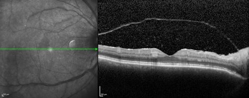 Birdshot Chorioretintis and PAMM
Patient presented with paracentral acute middle maculopathy as the presenting symptom of birdshot.  This case was published. RETINAL CASES & BRIEF REPORTS 10:151â€“153, 2016.
