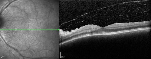 Birdshot Chorioretintis and PAMM
Patient presented with paracentral acute middle maculopathy as the presenting symptom of birdshot.  This case was published. RETINAL CASES & BRIEF REPORTS 10:151â€“153, 2016.
