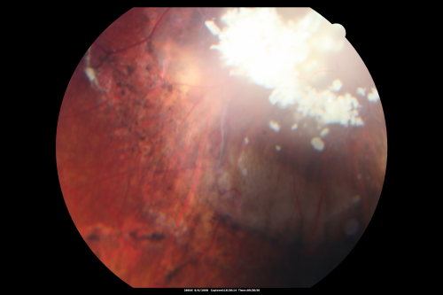 Retinoblastoma - Bilateral - Regressed - Chemotherapy, Thermal Therapy, Cryotherapy
10-year-old child was seen in the office on August 6, 2008.  She was treated with a combination of chemotherapy at 10 months old as well as thermal therapy and cryotherapy for bilateral retinoblastoma tumors.  She reportedly had nine tumors in the left eye and five tumors in the right eye
Võtmesõnad: retinoblastoma