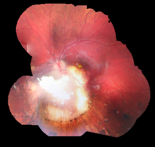 Retinoblastoma - Bilateral - Regressed - Chemotherapy, Thermal Therapy, Cryotherapy
10-year-old child was seen in the office on August 6, 2008.  She was treated with a combination of chemotherapy at 10 months old as well as thermal therapy and cryotherapy for bilateral retinoblastoma tumors.  She reportedly had nine tumors in the left eye and five tumors in the right eye
Keywords: retinoblastoma