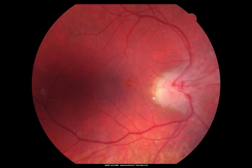 Retinoblastoma - Bilateral - Regressed - Chemotherapy, Thermal Therapy, Cryotherapy
10-year-old child was seen in the office on August 6, 2008.  She was treated with a combination of chemotherapy at 10 months old as well as thermal therapy and cryotherapy for bilateral retinoblastoma tumors.  She reportedly had nine tumors in the left eye and five tumors in the right eye
Keywords: retinoblastoma