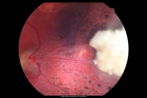 Retinoblastoma - Bilateral - Regressed - Chemotherapy, Thermal Therapy, Cryotherapy
10-year-old child was seen in the office on August 6, 2008.  She was treated with a combination of chemotherapy at 10 months old as well as thermal therapy and cryotherapy for bilateral retinoblastoma tumors.  She reportedly had nine tumors in the left eye and five tumors in the right eye
Keywords: retinoblastoma