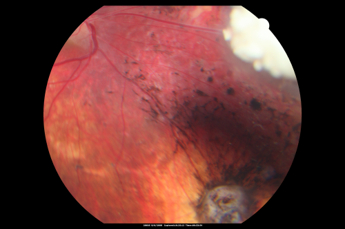 Retinoblastoma - Bilateral - Regressed - Chemotherapy, Thermal Therapy, Cryotherapy
10-year-old child was seen in the office on August 6, 2008.  She was treated with a combination of chemotherapy at 10 months old as well as thermal therapy and cryotherapy for bilateral retinoblastoma tumors.  She reportedly had nine tumors in the left eye and five tumors in the right eye
Keywords: retinoblastoma
