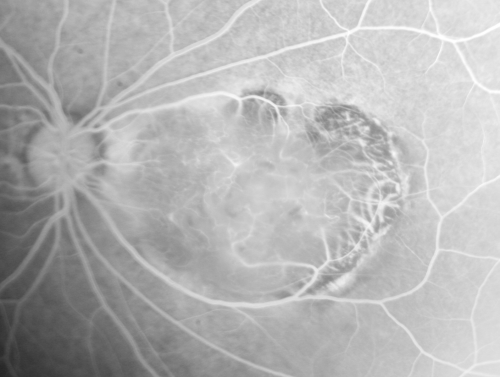 Retinocytoma - Retinoma - Regressed Retinoblastoma 43 year old male incidental finding 
