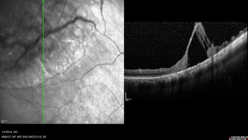 Retinoschisis - Superotemporally
Some line scans show RD and some showed retinoschisis.  Might have underlying RD that re-attached itself.
