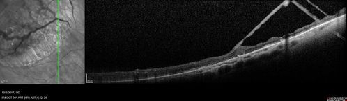 Retinoschisis - Superotemporally
Some line scans show RD and some showed retinoschisis.  Might have underlying RD that re-attached itself.
