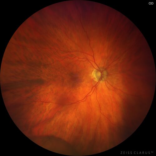 Retinoschisis confirmed with optical coherence tomography (OCT)
82 year old man with normal vision and peripheral retinoschisis confirmed with OCT scan.
