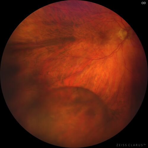 Retinoschisis confirmed with optical coherence tomography (OCT)
82 year old man with normal vision and peripheral retinoschisis confirmed with OCT scan.
