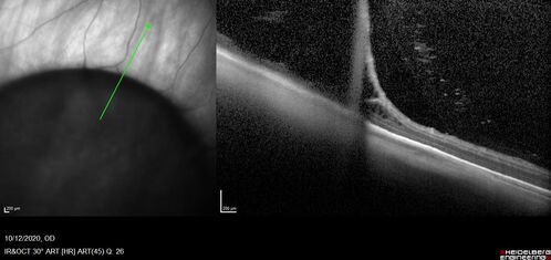 Retinoschisis confirmed with optical coherence tomography (OCT)
82 year old man with normal vision and peripheral retinoschisis confirmed with OCT scan.
