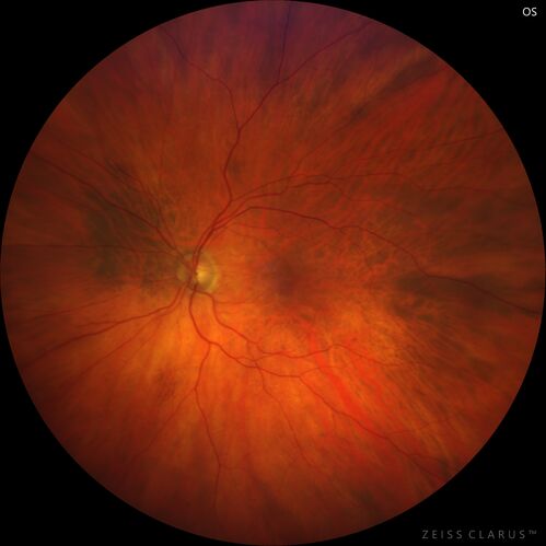 Retinoschisis confirmed with optical coherence tomography (OCT)
82 year old man with normal vision and peripheral retinoschisis confirmed with OCT scan.
