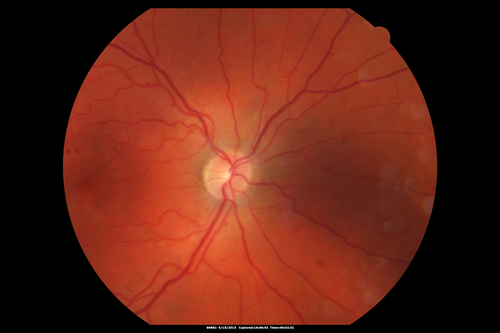 Multifocal Pattern Dystrophy
51 year old with normal vision - images look a lot like fundus flavimaculatus
