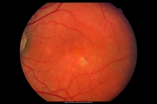 Multifocal Pattern Dystrophy
51 year old with normal vision - images look a lot like fundus flavimaculatus
