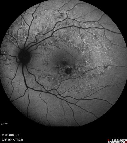 Multifocal Pattern Dystrophy
51 year old with normal vision - images look a lot like fundus flavimaculatus
