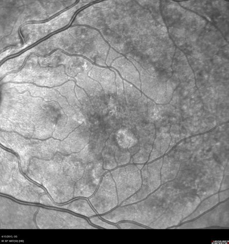 Multifocal Pattern Dystrophy
51 year old with normal vision - images look a lot like fundus flavimaculatus
