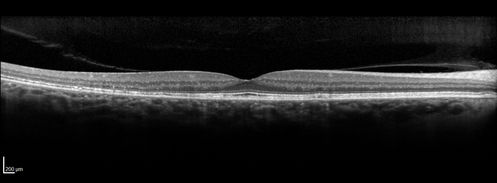 Multifocal Pattern Dystrophy
51 year old with normal vision - images look a lot like fundus flavimaculatus
