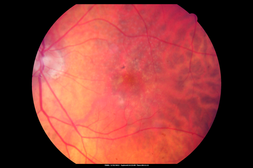 Reticular Macular Disease (Pseudo-drusen) Both Eyes - Occult CNVM and Macular Edema Right Eye 
Color Fundus Photo
