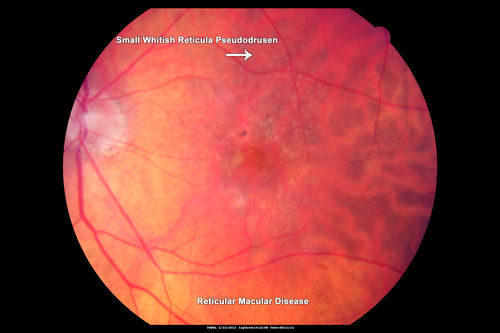 Reticular Macular Disease (Pseudo-drusen) Both Eyes - Occult CNVM and Macular Edema Right Eye 
Color Fundus Photo
