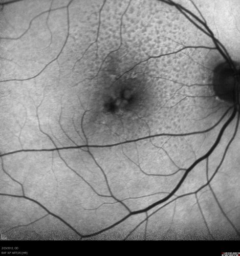 Reticular Macular Disease (Pseudo-drusen) Both Eyes - Occult CNVM and Macular Edema Right Eye 
Fundus Autofluorescence
