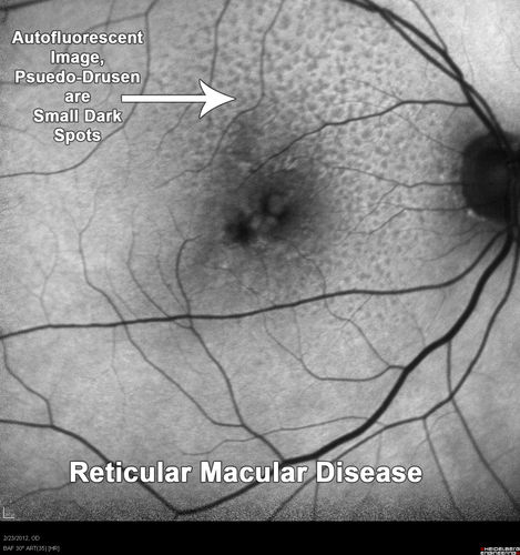 Reticular Macular Disease (Pseudo-drusen) Both Eyes - Occult CNVM and Macular Edema Right Eye 
Fundus AutofluorescenceFundus Autofluorescence
