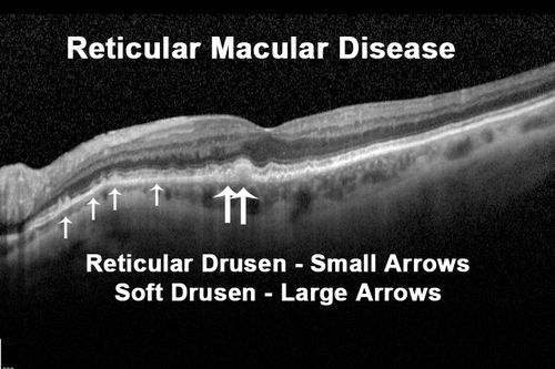 Reticular Macular Disease (Pseudo-drusen) Both Eyes - Occult CNVM and Macular Edema Right Eye 
Spectral Domain Optical Coherence Tomography
