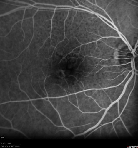 Reticular Macular Disease (Pseudo-drusen) Both Eyes - Occult CNVM and Macular Edema Right Eye 
Fluorescein Angiogram
