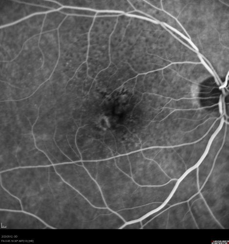 Reticular Macular Disease (Pseudo-drusen) Both Eyes - Occult CNVM and Macular Edema Right Eye 
Fluorescein Angiogram
