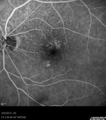 Reticular Macular Disease (Pseudo-drusen) Both Eyes - Occult CNVM and Macular Edema Right Eye 
Fluorescein Angiogram
