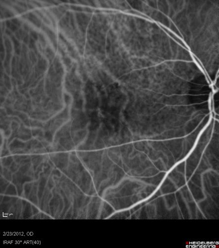 Reticular Macular Disease (Pseudo-drusen) Both Eyes - Occult CNVM and Macular Edema Right Eye 
Indocyanine Green Angiogram
