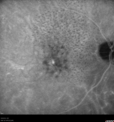 Reticular Macular Disease (Pseudo-drusen) Both Eyes - Occult CNVM and Macular Edema Right Eye 
Indocyanine Green Angiogram
